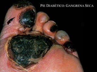PIE DIABÉTICO: GANGRENA SECA
 