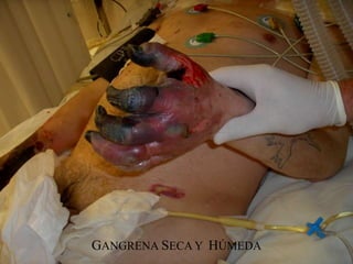 GANGRENA SECA Y HÚMEDA
 