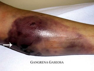 GANGRENA GASEOSA
 