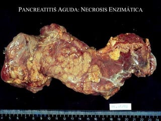 PANCREATITIS AGUDA: NECROSIS ENZIMÁTICA
 