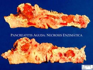 PANCREATITIS AGUDA: NECROSIS ENZIMÁTICA
 