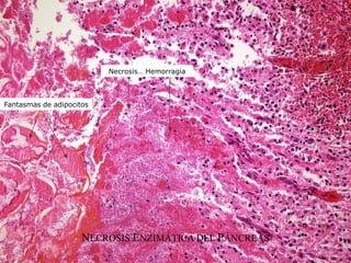 Fantasmas de adipocitos
Necrosis… Hemorragia
NECROSIS ENZIMÁTICA DEL PÁNCREAS
 