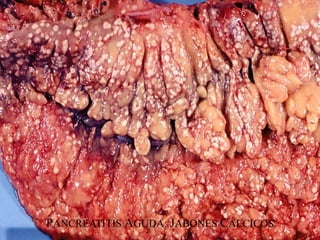 PANCREATITIS AGUDA: JABONES CÁLCICOS
 