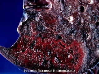 PULMÓN: NECROSIS HEMORRAGICA
 