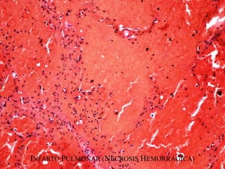 INFARTO PULMONAR (NECROSIS HEMORRÁGICA)
 
