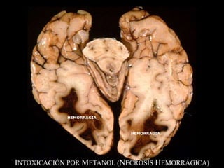 INTOXICACIÓN POR METANOL (NECROSIS HEMORRÁGICA)
HEMORRAGIA
HEMORRAGIA
 