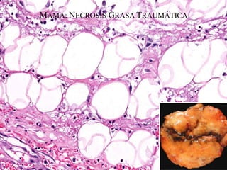 MAMA: NECROSIS GRASA TRAUMÁTICA
 