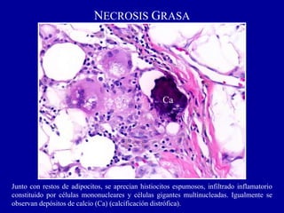 NECROSIS GRASA
Ca
Junto con restos de adipocitos, se aprecian histiocitos espumosos, infiltrado inflamatorio
constituido por células mononucleares y células gigantes multinucleadas. Igualmente se
observan depósitos de calcio (Ca) (calcificación distrófica).
 
