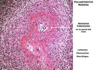 NECROSIS
FIBRINOIDE
en la pared del
vaso
Linfocitos
Plasmacitos
Macrófagos
POLIARTERITIS
NODOSA
 