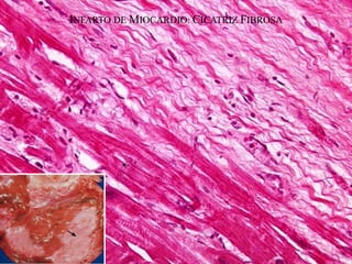 INFARTO DE MIOCARDIO: CICATRIZ FIBROSA
 