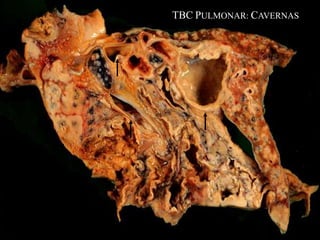 TBC PULMONAR: CAVERNAS
 