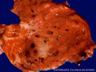ESTÓMAGO: ÚLCERAS DE ESTRÉS
 