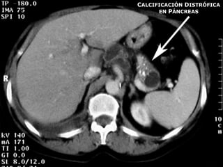 CALCIFICACIÓN DISTRÓFICA
EN PÁNCREAS
 