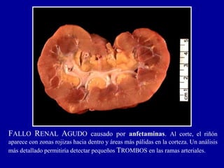 Biopatología estructural de las ram 3 lesiones renales | PPTX