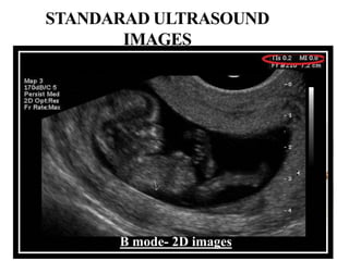 STANDARAD ULTRASOUND
IMAGES
B mode- 2D images
 