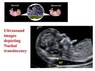 Ultrasound
images
depicting
Nuchal
translucency
 