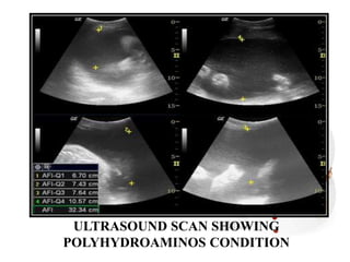 ULTRASOUND SCAN SHOWING
POLYHYDROAMINOS CONDITION
 