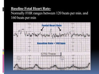 Baseline Fetal Heart Rate-
Normally FHR ranges between 120 beats per min. and
160 beats per min
 