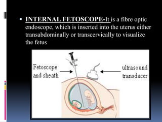  INTERNAL FETOSCOPE-It is a fibre optic
endoscope, which is inserted into the uterus either
transabdominally or transcervically to visualize
the fetus
 