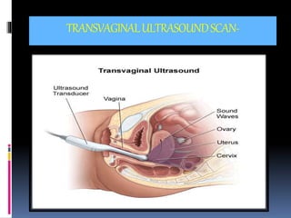 TRANSVAGINALULTRASOUNDSCAN-
 