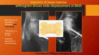 Bma Inj Image Bioplasty | PPTX