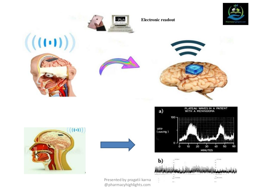 WIRELESS BRAIN SENSORS