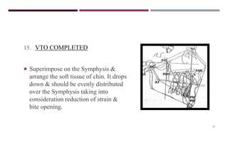 38
15. VTO COMPLETED
 Superimpose on the Symphysis &
arrange the soft tissue of chin. It drops
down & should be evenly distributed
over the Symphysis taking into
consideration reduction of strain &
bite opening.
 