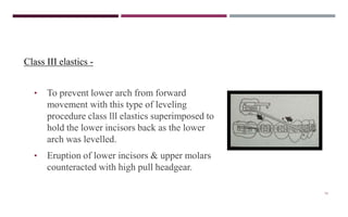 74
Class III elastics -
• To prevent lower arch from forward
movement with this type of leveling
procedure class lll elastics superimposed to
hold the lower incisors back as the lower
arch was levelled.
• Eruption of lower incisors & upper molars
counteracted with high pull headgear.
 