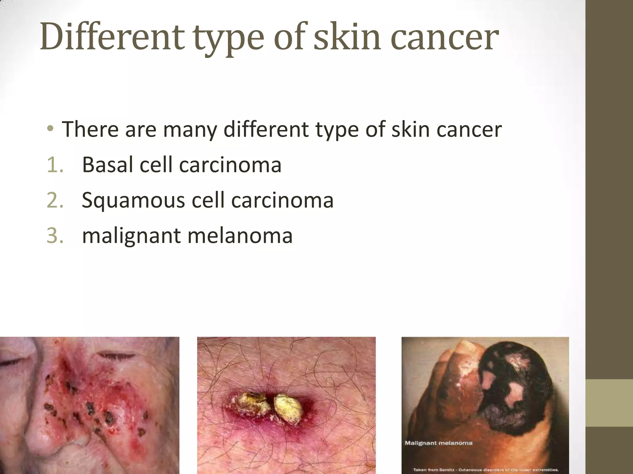 Different type of skin cancer
• There are many different type of skin cancer
1. Basal cell carcinoma
2. Squamous cell carcinoma
3. malignant melanoma