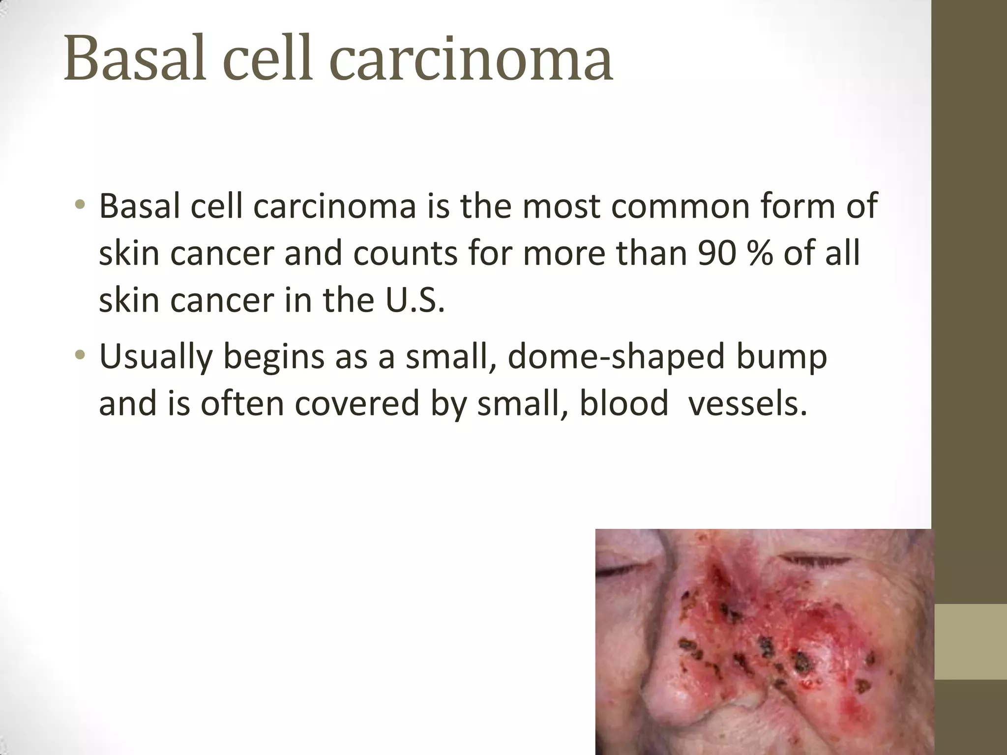 Basal cell carcinoma
• Basal cell carcinoma is the most common form of
skin cancer and counts for more than 90 % of all
skin cancer in the U.S.
• Usually begins as a small, dome-shaped bump
and is often covered by small, blood vessels.