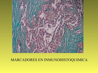 MARCADORES EN INMUNOHISTOQUIMICA
 