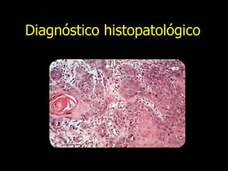 Diagnóstico histopatológico 