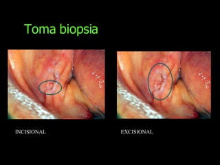 Toma biopsia INCISIONAL EXCISIONAL 