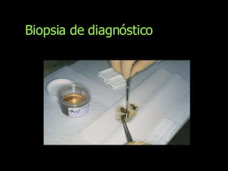 Biopsia de diagnóstico 