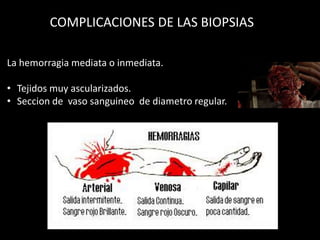 COMPLICACIONES DE LAS BIOPSIAS
La hemorragia mediata o inmediata.
• Tejidos muy ascularizados.
• Seccion de vaso sanguineo de diametro regular.
 