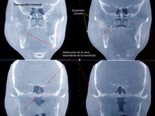Tomografía coronal
                            Expansión
                             tumoral




                     Des...