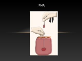 FNA
 