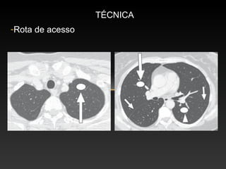 TÉCNICA
-Rota de acesso
 