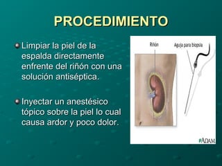 Biopsia Riñon Biopsia renal | PPT