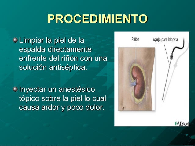 Duele los riñones ir