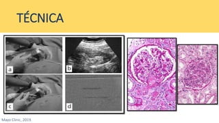 Biopsia Riñon Biopsia renal | PPTX