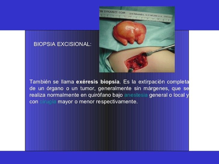 Tipos De Biopsia