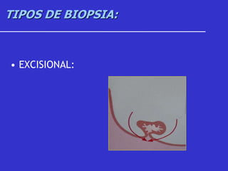 TIPOS DE BIOPSIA:
• EXCISIONAL:
 