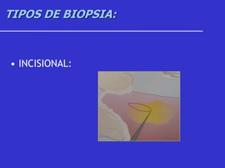 TIPOS DE BIOPSIA:
• INCISIONAL:
 