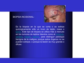 BIOPSIA
BIOPSIA INCISIONAL:
Es la biopsia en la que se corta o se extirpa
quirúrgicamente sólo un trozo de tejido, masa o
tumor. Este tipo de biopsia se utiliza más a menudo
en los tumores de tejidos blandos como el músculo,
cerebro, hígado, pulmón, para distinguir patología
benigna de la maligna, porque estos órganos no se
pueden extirpar, o porque la lesión es muy grande o
difusa.
 