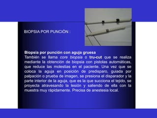 BIOPSIA
BIOPSIA POR PUNCIÒN :
Biopsia por punción con aguja gruesa
También se llama core biopsia o tru-cut que se realiza
mediante la obtención de biopsia con pistolas automáticas,
que reduce las molestias en el paciente. Una vez que se
coloca la aguja en posición de predisparo, guiada por
palpación o prueba de imagen, se presiona el disparador y la
parte interior de la aguja, que es la que succiona el tejido, se
proyecta atravesando la lesión y saliendo de ella con la
muestra muy rápidamente. Precisa de anestesia local.
 