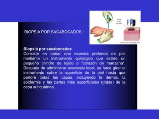 BIOPSIA
BIOPSIA POR SACABOCADOS :
Biopsia por sacabocados
Consiste en tomar una muestra profunda de piel
mediante un instrumento quirúrgico que extrae un
pequeño cilindro de tejido o "corazón de manzana".
Después de administrar anestesia local, se hace girar el
instrumento sobre la superficie de la piel hasta que
perfore todas las capas, incluyendo la dermis, la
epidermis y las partes más superficiales (grasa) de la
capa subcutánea.
 