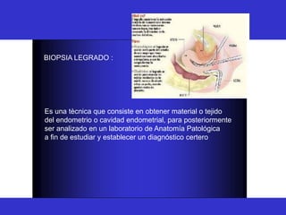 BIOPSIA
BIOPSIA LEGRADO :
Es una tècnica que consiste en obtener material o tejido
del endometrio o cavidad endometrial, para posteriormente
ser analizado en un laboratorio de Anatomía Patológica
a fin de estudiar y establecer un diagnóstico certero
 
