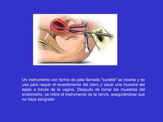 Un instrumento con forma de pala llamado "curette" se inserta y se
usa para raspar el revestimiento del útero y sacar una muestra del
tejido a través de la vagina. Después de tomar las muestras del
endometrio, se retira el instrumento de la cervix, asegurándose que
no haya sangrado.
 