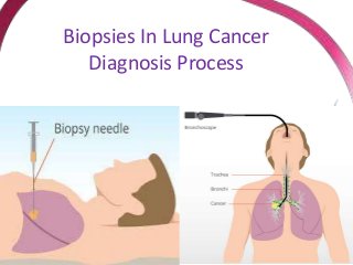 Biopsies In Lung Cancer
Diagnosis Process
 
